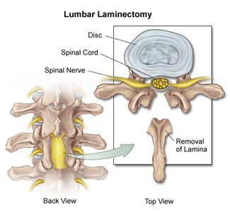 لامینوکتومی برای درمان تنگی کانال 