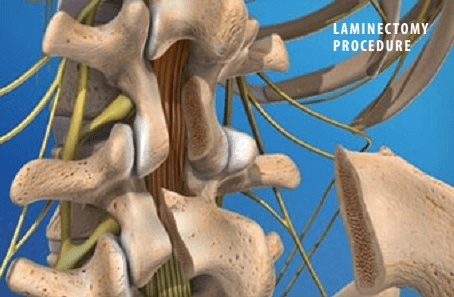 سندرم پس از لامینکتومی (دردهای باقیمانده بعد از جراحی باز ستون فقرات)
