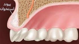 پیوند استخوان دندان