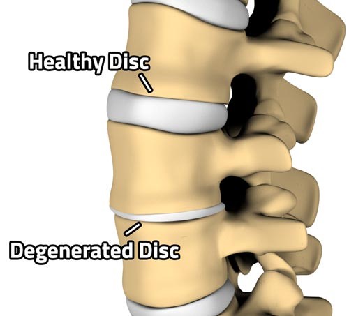 بیماری فرسایش دیسک یا دژنراتیو دیسک (degenerative Disc disease)