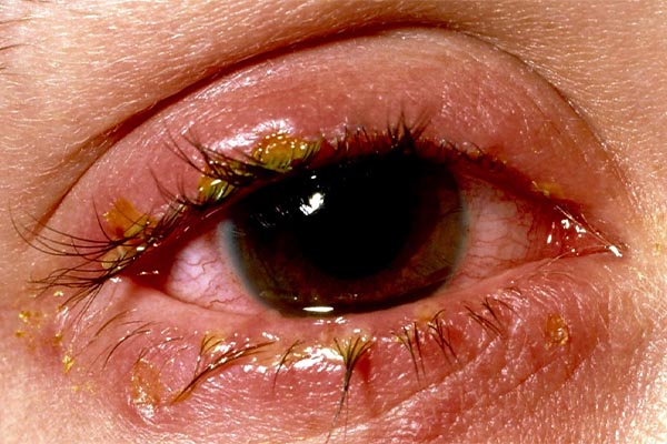 التهاب قرنیه یا کراتیت در اثر عفونت‌های باکتریایی در این تصویر قابل مشاهده است.