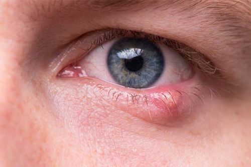 یکی از علل ایجاد ورم چشم، سلولیت است.