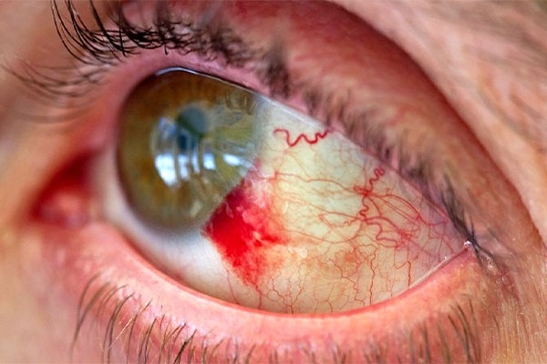 یکی از التهاب‌های چشمی دردناک کراتیت است.