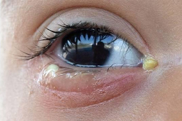 سلولیت چشمی در کودکان زیر 6 سال بیشتر دیده‌ می‌شود و باعث ورم پلک و حساسیت به لمس و عفونت چشمی کودک می‌گردد.