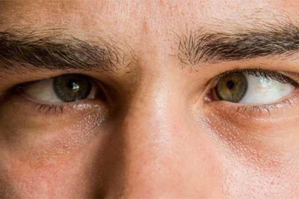 انحراف چشم یکی از بیماری های چشمی است که باعث می شود تا چشم ها در یک راستا قرار نگیرند.