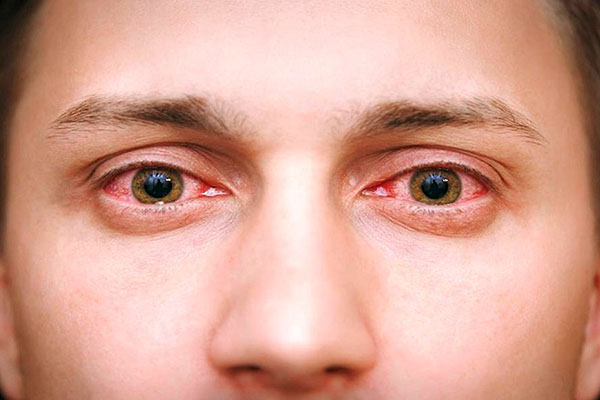 یکی از بیماری‌های رایج چشمی، التهاب چشم است.