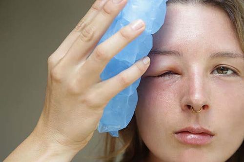 استفاده از کمپرس سرد و گرم می تواند به درمان ورم چشم کمک کند.