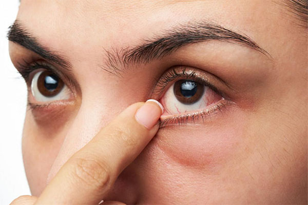 تبخال چشم توسط ویروس هرپس ایجاد می‌شود و باعث عارضه چشمی مثل تاری دید یا سوزش برای افراد می شود.
