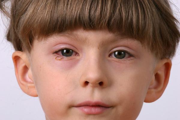 باکتری‌ها می‌توانند یکی از علت‌های ایجاد عفونت در چشم کودک باشند.