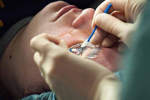 بر اساس تحقیقات انجام شده رضایت از عمل لیزیک به میزان قابل توجهی بیشتر از مابقی روش‌های عمل چشم مانند لنز‌های طبی بوده است. 