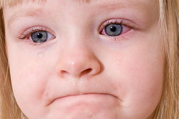 شالازیون یکی از بیماری‌های چشمی است که در کودکان ایجاد می‌شود و به‌مرور زمان از بین می‌رود.