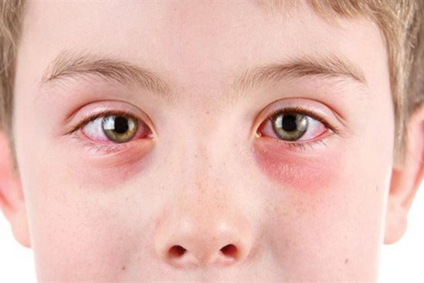 علائم التهاب چشم در هر فردی متفاوت است.