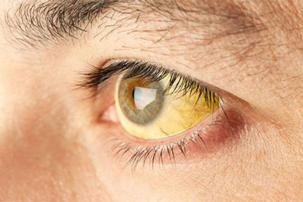 درمان زردی چشم با توجه به تشدید آن متفاوت است.