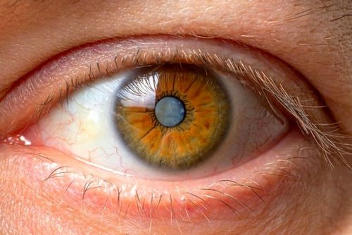 تنبلی چشم یکی از بیماری های چشمی است که به دلایل مختلفی ایجاد می شود.