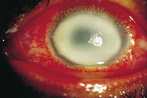 عفونت چشم ممکن است در مواردی باعث نابینایی شود.
