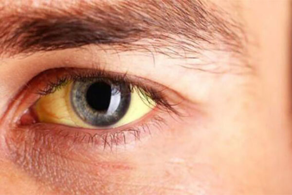 در این تصویر زرد شدن سفیدی چشم قابل مشاهده است.