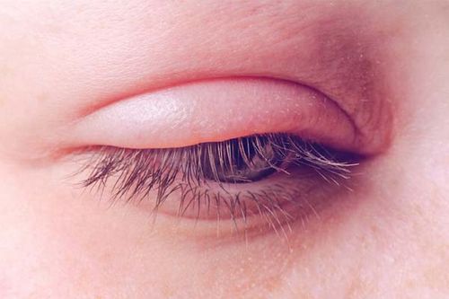 آلرژی یکی از دلایل ایجاد ورم چشم است.