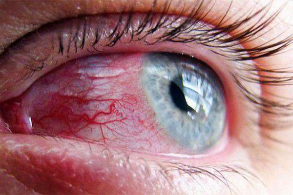 از عوارض التهاب چشم می‌توان به زخم قرنیه اشاره کرد.