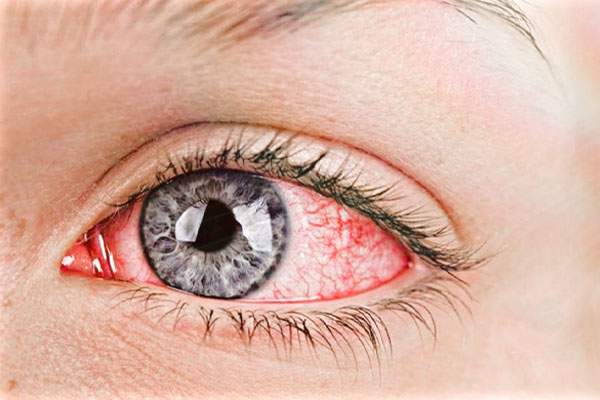 قرمزی چشم یا red eye از امراض چشمی است.
