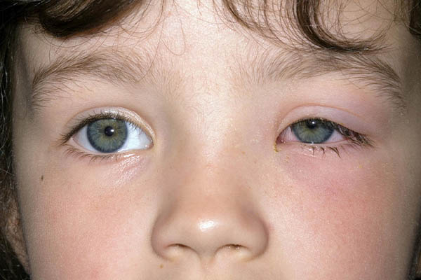 تماس با اشیا آلوده یکی از دلایل التهاب پلک کودکان است.