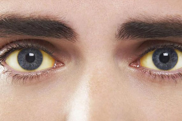 سندروم گیلبرت از دلایل زردی چشم است.