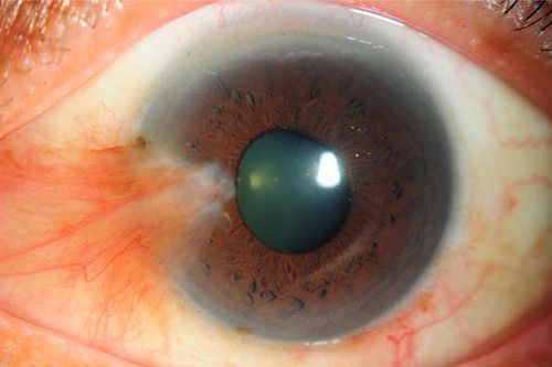 گاهی ناخنک چشم، در قسمت‌های دیگر چشم نیز تشکیل می‌شود.