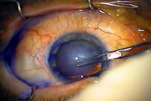 در هنگام عمل لیزیک کلیه حرکات چشم بیمار به صورت کامل مدیریت می‌شود.
