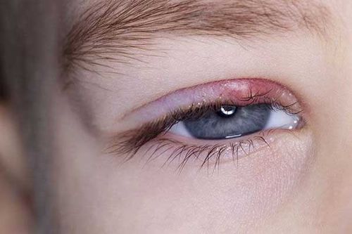  گل مژه یکی از عفونت های چشم رایج است.