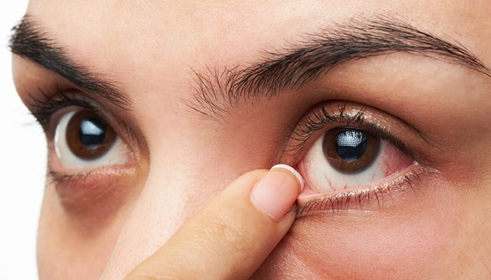 افرادی که خشکی چشم دارند واجد شرایط عمل لیزیک نیستند.