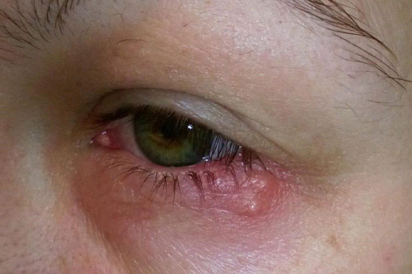 تبخال چشمی انواع مختلفی مثل کراتیت هرپس، ایریدوسیکلیت و کراتیت استروما دارد.