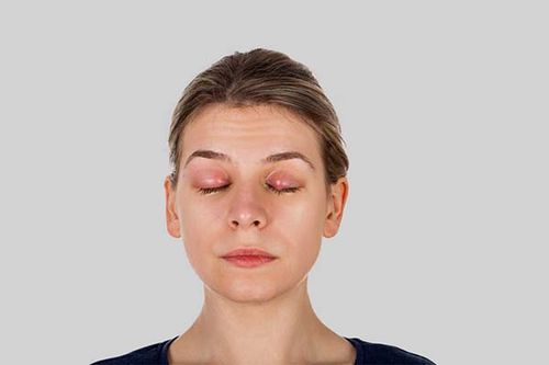 ورم چشم یکی از بیماری های رایج چشمی است.