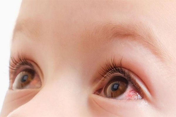 انسداد مجرای اشکی چشم در کودکان باعث قرمزی و تاری‌دید کودک می‌شود.