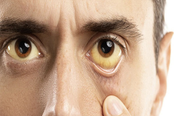 زرد شدن سفیدی چشم، دلایل متفاوتی دارد.