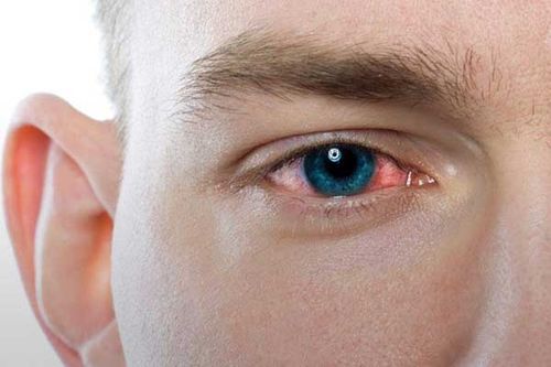 عفونت چشم انواع مختلفی دارد.