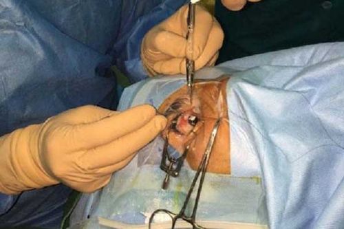 پلک‌های بیمار در هنگام عمل چشم ( لیزیک ) فیکس شده‌اند. 
