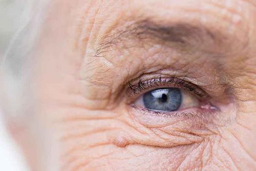 پیر چشمی یکی از بیماری های شایع در دوران جوانی و میانسالی است.