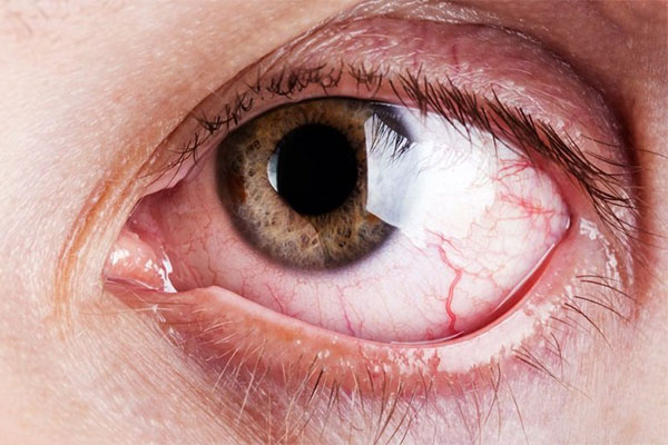 زمانی که باکتری وارد چشم می‌شود، سبب عفونت چشم می‌شود.