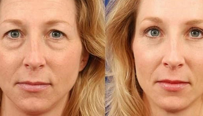 تفاوت قبل و بعد از جراحی پلک در این تصویر قابل مشاهده است!