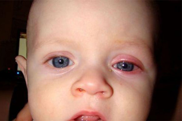 ورم ملتحمه در کودکان که به چشم صورتی معروف است، باعث ایجاد التهاب و قرمزی چشم کودک می‌شود.