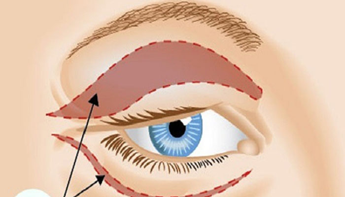 بلفاروپلاستی، شامل جراحی پف چشم، جراحی پلک بالا و پایین می‌شود.