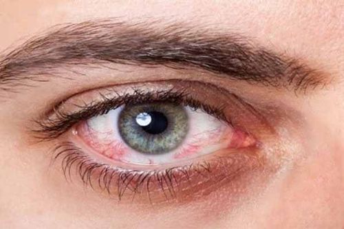 انحراف چشم از بیماری های رایج چشم در کودکان است که تا قبل از 6 سالگی راحت تر درمان می شود.