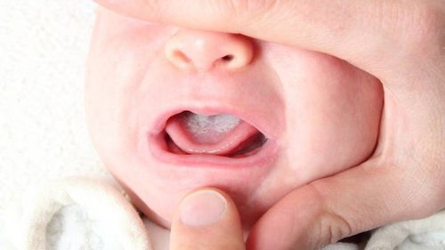 تشخیص آفت دهان نوزادان از طریق بررسی علائم ظاهری و ارزیابی بالینی صورت می‌پذیرد.