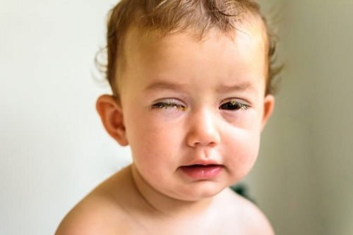 کودک با بیماری عفونت چشم نمایش داده شده است.