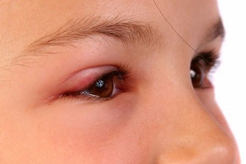 بیماری عفونت چشم کودکان در تصویر نشان داده شده است.