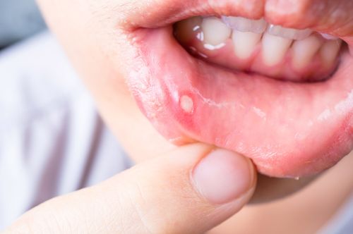 علت اصلی آفت دهان نوزادان هنوز مشخص نیست