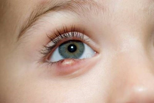 کودک دچار بیماری عفونت چشم نمایش داده شده است.