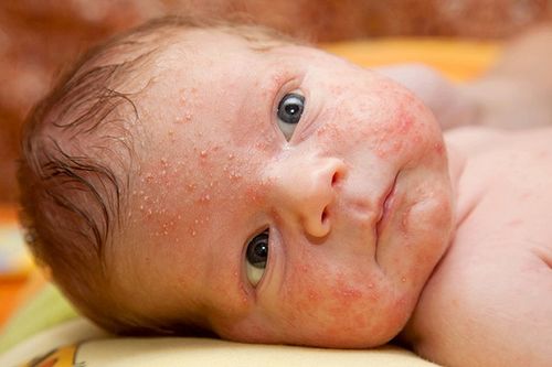 عفونت پوستی کودکان انواع مختلفی دارد.