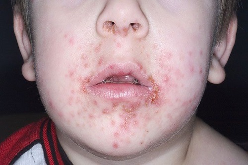 در عفونت پوستی کودکان، پوست قرمزی، درد و خارش دارد.
