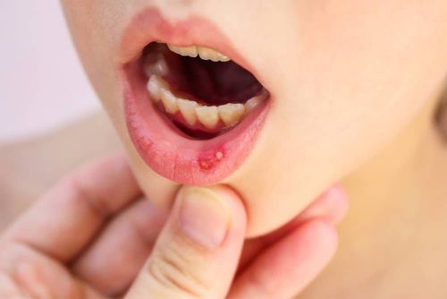 واص ضدباکتریایی و التیام‌بخش عسل می‌تواند در درمان آفت دهان نوزادان مفید باشد. 